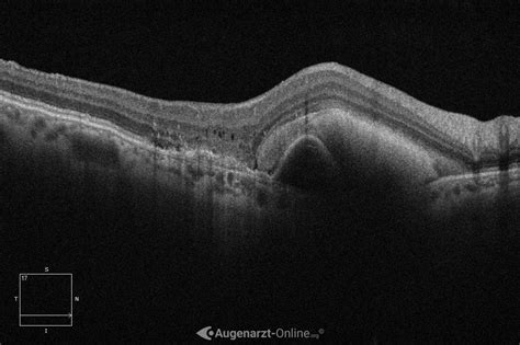 Makulablutung Atlas Der Augenheilkunde
