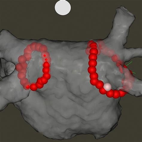 Electroanatomical Map Of The Left Atrium After Pulmonary Vein Isolation