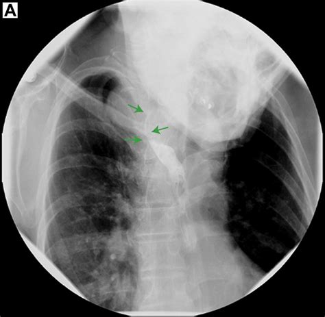 Dysphagia Lusoria