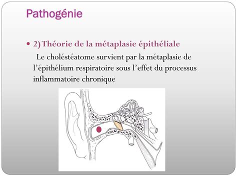 Ppt Lotite Moyenne Chronique Cholestéatomateuse Powerpoint