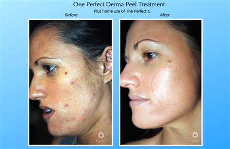 The Perfect Derma Peel Advanced Skin Body Solutions