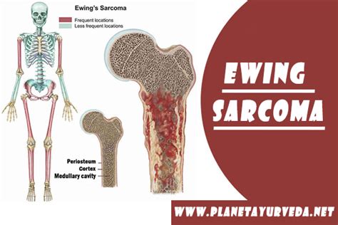 Ayurvedic Treatment of Ewing Sarcoma