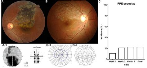 Examples Of Fundus Photographs And Visual Field Examinations In