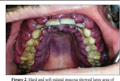 Figure 1 From Diagnosis Of Acute Myeloid Leukemia In A Dental Hospital