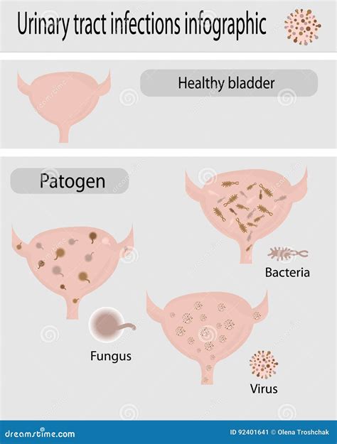 Urinary Tract Infection Pyelonephritis Cartoon Vector CartoonDealer