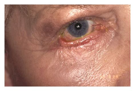 Lower Eyelid Of This Patient Shows Cicatricial Ectropion With Middle