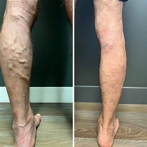 Before And After Vein Photos Of Varicose And Spider Veins Ithriveveins