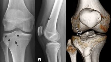 Radiographic Signs of Type 3A Schatzker Fracture of Lateral Tibial ...