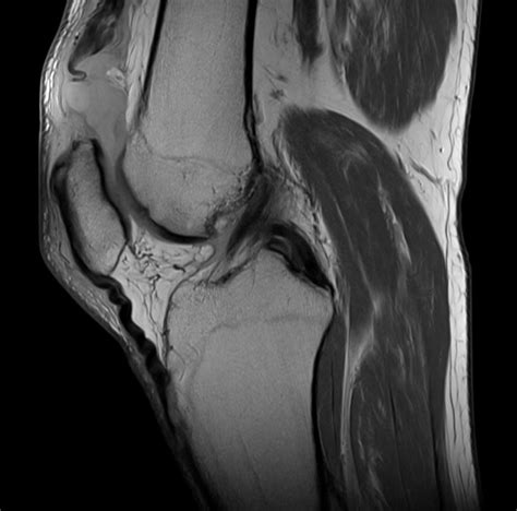 Knee Extensor Mechanism Structure Traumas And Interventions Centre