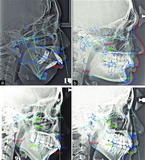 Variation Of Skeletal Class Ii Malocclusion In Javanese Population A Download Scientific