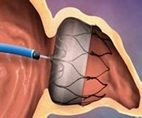 The Watchman DeviceAtrial Fibrillation: Resources for Patients