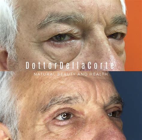 Blefaroplastica Napoli Dottor Della Corte