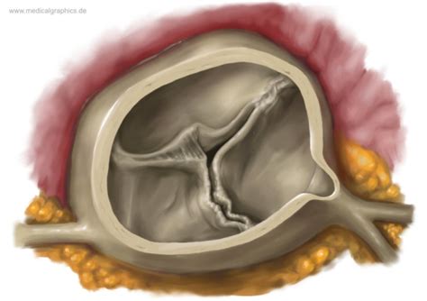 Free Illustration Aortic Valve Moderate Stenosis