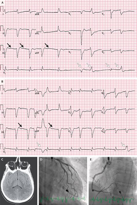 Case 30 2020 A 54 Year Old Man With Sudden Cardiac Arrest Nejm