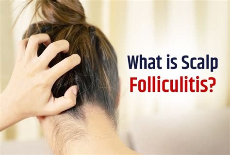 Bacterial Folliculitis Scalp