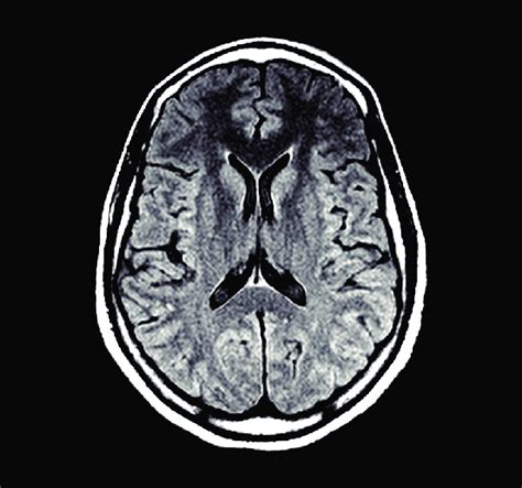 Chronic Microvascular Ischemic Changes Slideshare