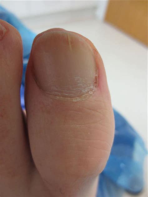 Fungal Nail | Total Foot Health