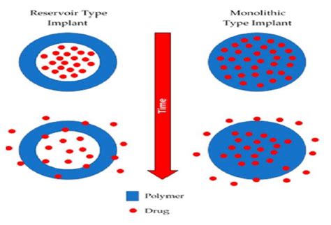 Implantable Drug Delivery System An Overview