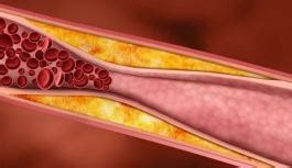 Arteriosclerosis – Symptoms, causes and treatments – article1000.com