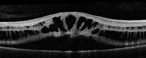 Retinoschisis causes, symptoms, diagnosis & retinoschisis treatment