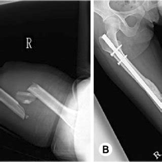 A Preoperative Radiographs Of A 21 Year Old Woman With A Closed