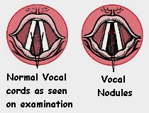 Vocal Nodules (AKA Nodes) | Trust Dramaturgy for The Theatre School