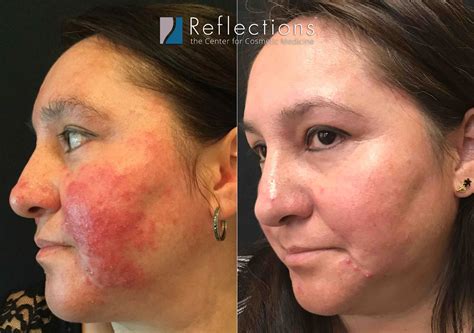 Rosacea Laser Treatment