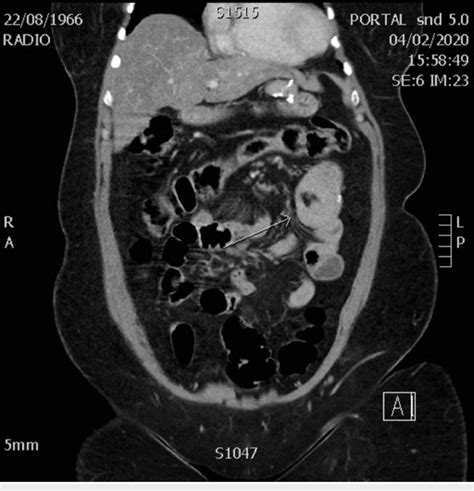 Coronal View Of The Ct Scan Showing Intussusception At Level Of