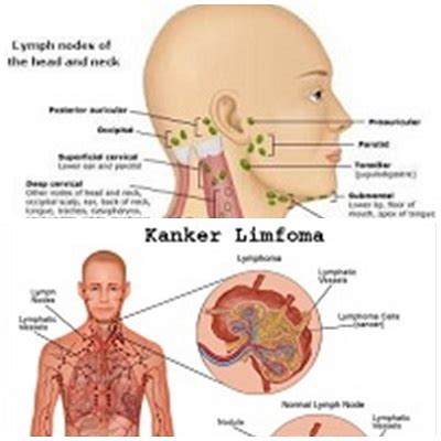 Limfoma Adalah Penyakit Homecare