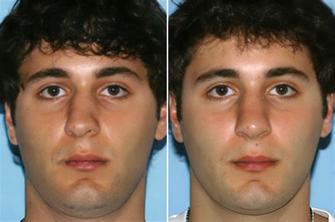 Week By Week Guide To Rhinoplasty Recovery Beverly Hills