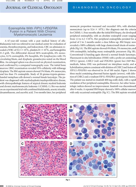 Eosinophilia With Fip1l1 Pdgfra Fusion In A Patient With Chronic