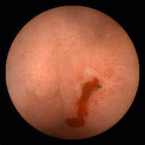 Bleeding Duodenal Ulcer Pill Camera View Photograph By David M Martin Md Pixels