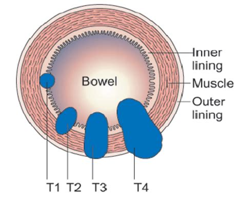 Rectal Cancer T Stage