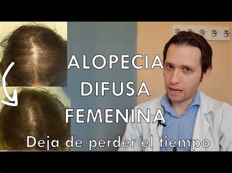 Cortes de pelo para mujeres con alopecia androgenética encuentra el