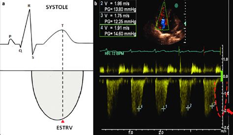 A B Diagram Showing The Tricuspid Regurgitation Flow Across The