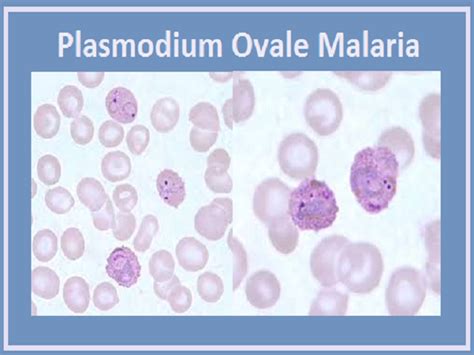 Plasmodium Vivax Images