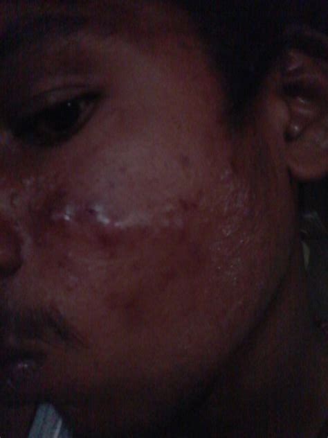 effect of psoriasis : r/PsoriasisRemedies