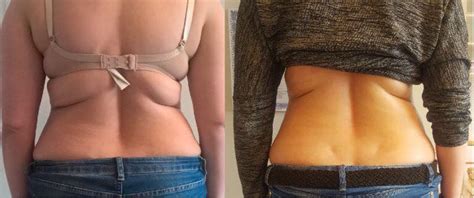 Velashape Before And After Vivalaser For You For All For Beauty