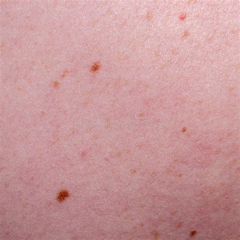 Nevus Or Mole On The Human Body Close Up Skin Cancer Keratosis Or