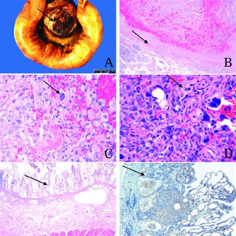 Pdf Primary Mesenteric Angiosarcoma In A Child With Associated