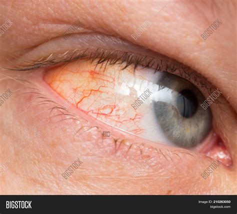 Chronic Conjunctivitis Image & Photo (Free Trial) | Bigstock