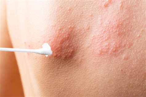 Mild Shingles Symptoms