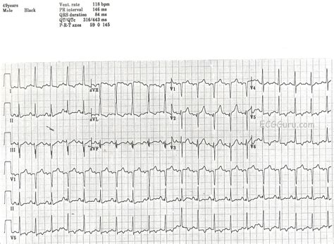 T Wave Inversion | ECG Guru - Instructor Resources