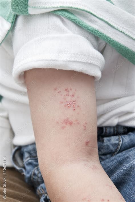 Ampollas Del Herpes Zoster En El Brazo De Un Ni O Foto De Stock