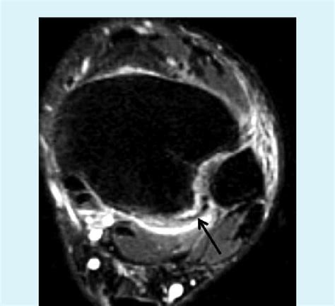 Anterior tibiofibular ligament tear (arrow). The ligament is edematous... | Download Scientific ...