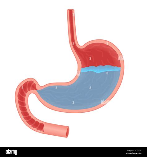 Vector Medical illustration about acid in stomach. Stomach acid reflux ...