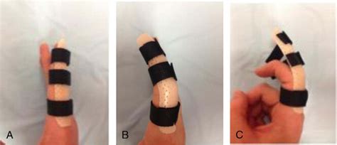 A, Dorsal blocking splint in neutral, (B) DBS in 30° flexion, and (C)... | Download Scientific ...