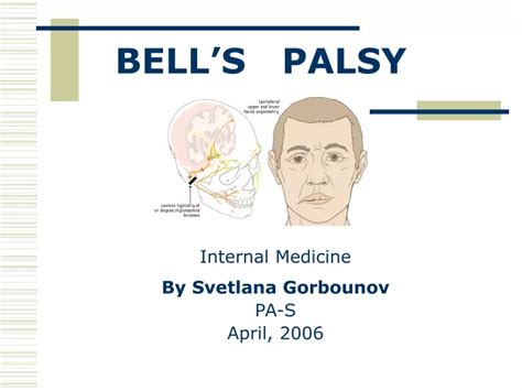 Ppt Bells Palsy Powerpoint Presentation Free Download Id9369592