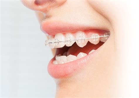 Types Of Braces Specialist Orthodontist In Dublin Dundrum Orthodontics