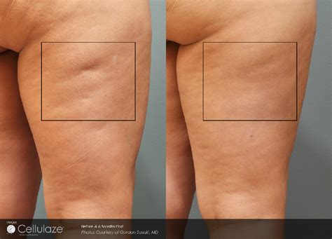 Cellulaze San Ramon California Dermatology